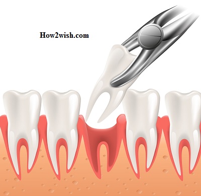 How to remove the root of a tooth