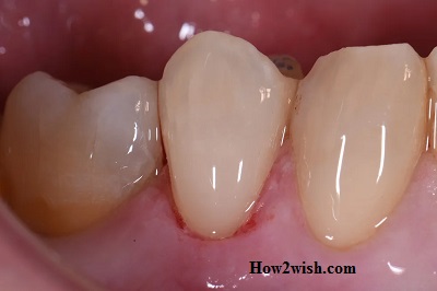 Symptoms of abrasion of teeth.jpg