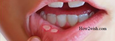 Symptoms of stomatitis in the mouth