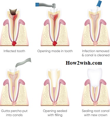 Tooth cleaning treatment