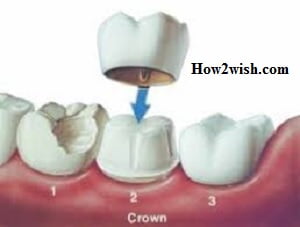 Types of crowns for teeth