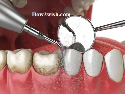 Types of teeth cleaning and polishing
