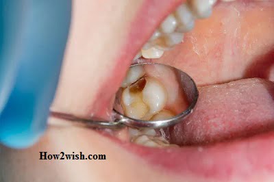 causes of dental pulpitis
