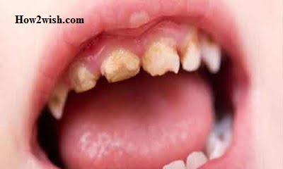 causes of teeth collapse