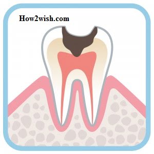 crown root canal fell off