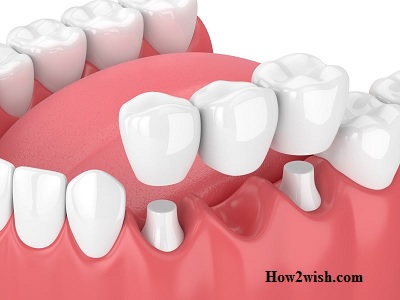 crowns or implants for front teeth