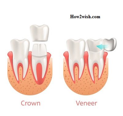 difference between veneers and crowns