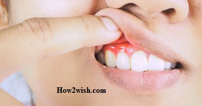 gums receding symptoms