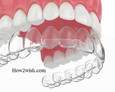 how do aligners straighten your teeth