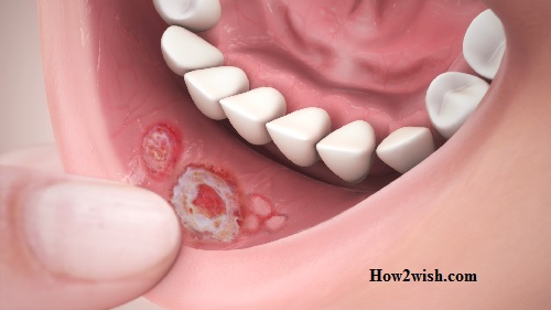 inflammation of the tissue in the mouth