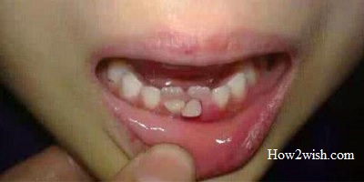 pictures of double teeth