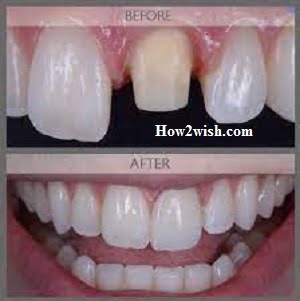 crowns for teeth cost