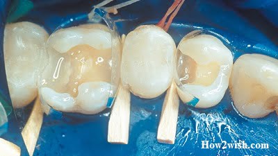 types of dental restorations