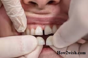 types of veneers for teeth