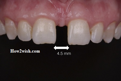 Diastema of Teeth