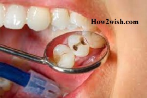 Diseases of the Teeth