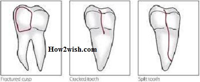 Teeth Crack classification