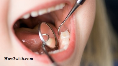 The order of teething of milk teeth in children