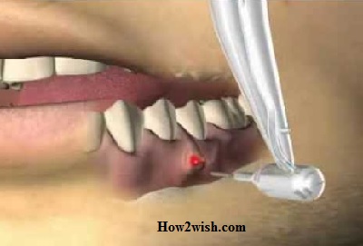 Treating a Cyst in Your Tooth