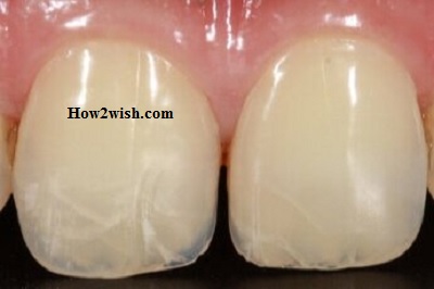 Treatment teeth crack