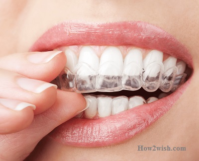 Types of braces