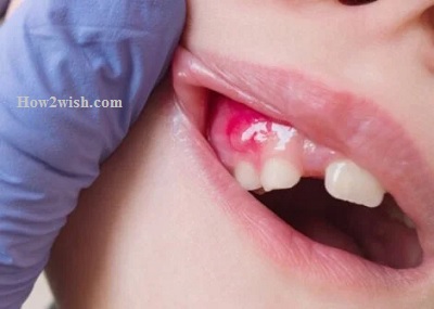 What causes a fistula on the gum