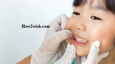 White spots on milk teeth Treat