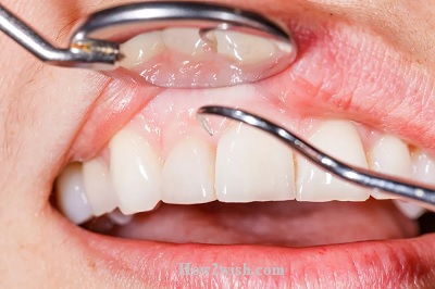 periodontitis causes