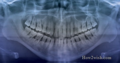 periodontitis vs gingivitis