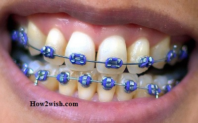 what are braces power chains